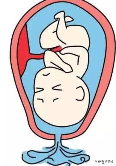 如何预防早期血栓的发生,如何预防早上起来眼睛肿