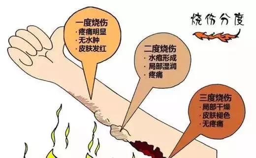 开水烫伤应急处理方法有哪些,开水烫伤怎么处理最有效的方法