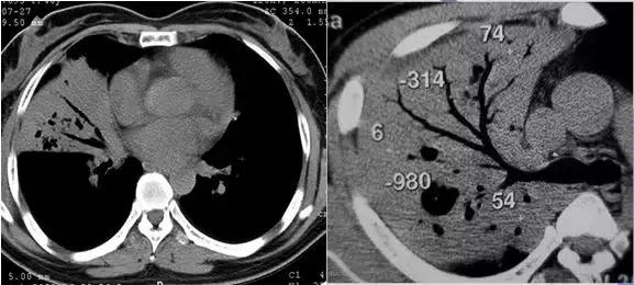 肺部ct十大征象,肺部ct正常图和异常图的区别