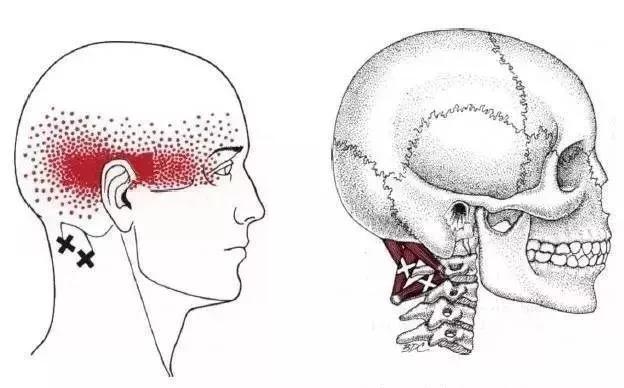 偏头痛的部位是哪里,偏头痛的原始痛点