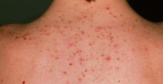 后背痘痘小红疙瘩都是螨虫,后背长痘痘到底是湿疹还是螨虫