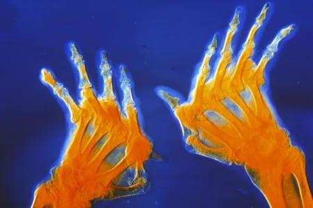 手指风湿性关节炎症状和治疗方法,风湿性关节炎症状和治疗方法成都