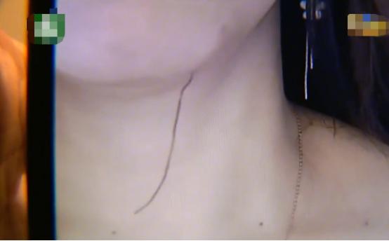 脸部填充手术案例,开腹手术美容线线头露出来怎么办