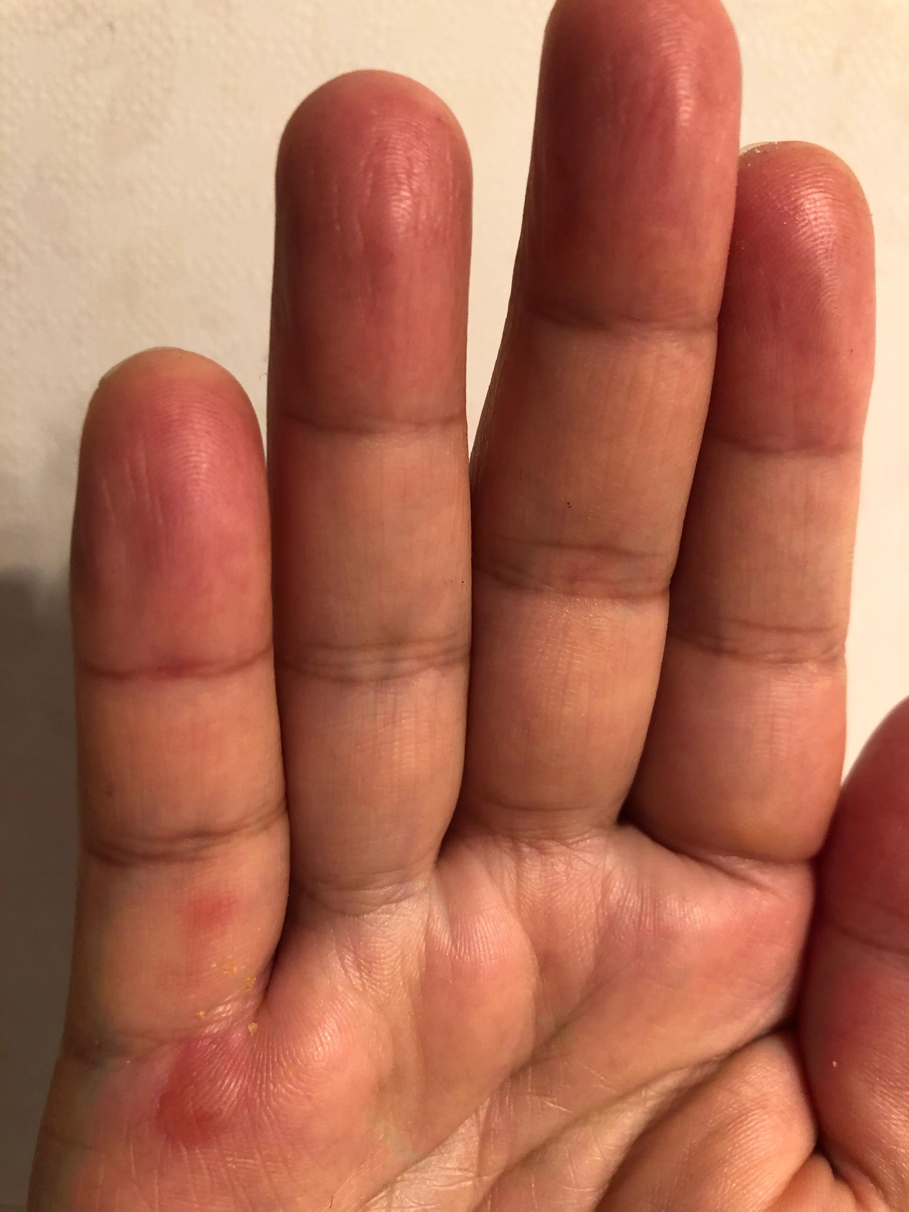 油煎了手起泡怎么办,油煎柿子糕