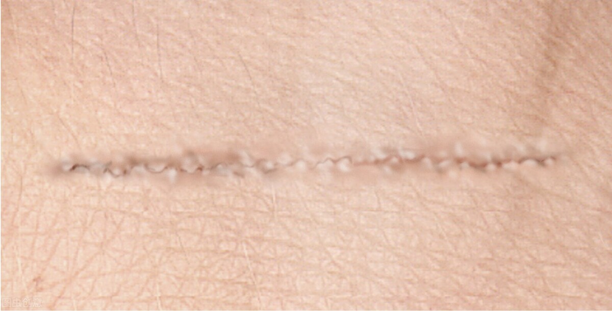 如何有效去除新疤痕,祛除疤痕的药可以祛除痘印吗