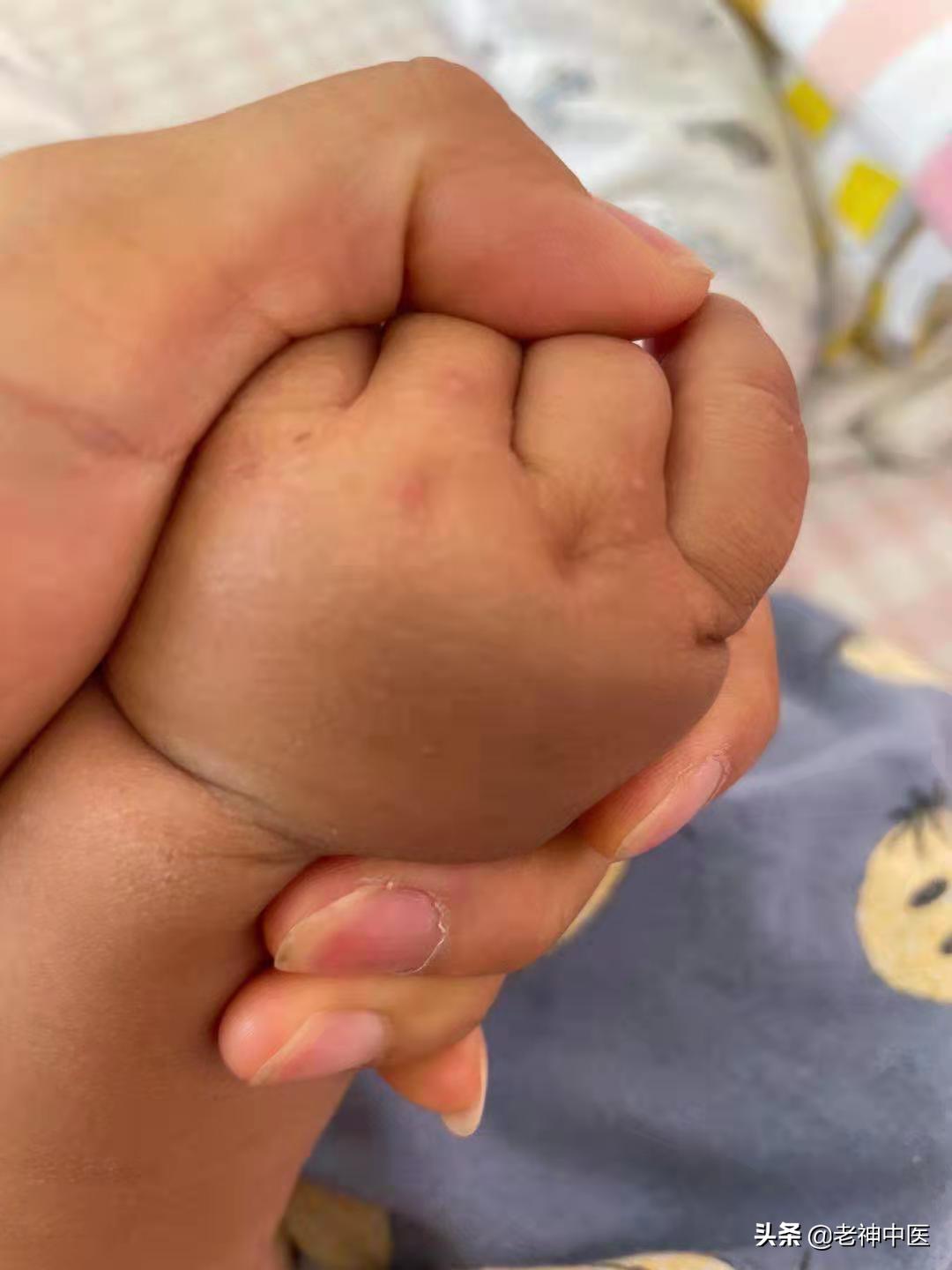 成人手足口病传染,儿童手足口病怎么传染的