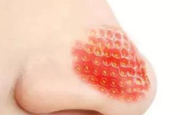 清理黑头最好用的办法,去黑头的最好方法不用清洁