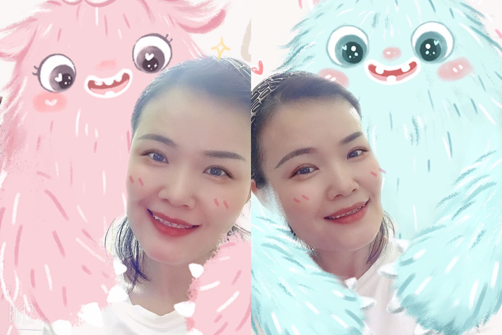 眼球突出割双眼皮好看吗,割双眼皮的危害