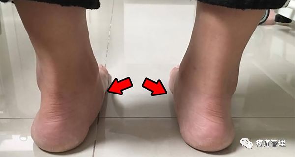 专门改善扁平足的运动,站着改善小腿外翻