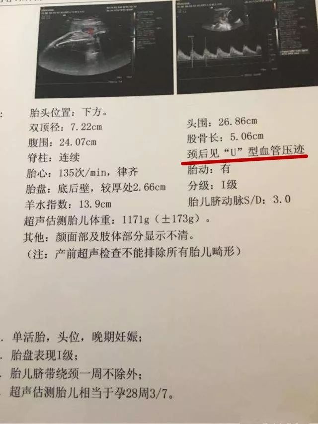 脐带绕颈几圈符合剖腹产指标,头位未入盆脐带绕颈两圈顺还是剖