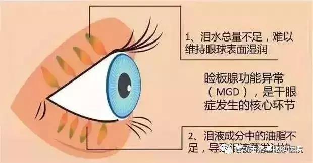 被诊断轻度干眼症能完全治好吗,干眼症眼睛痛怎么办