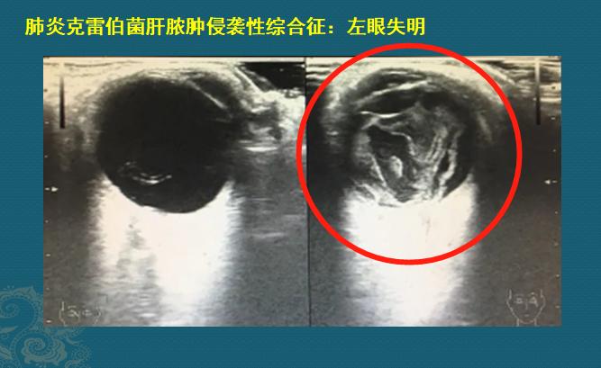 糖尿病人不要犟,有1种细菌喜欢喝糖浆,感染眼睛会失明