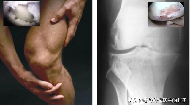 膝盖有骨刺应该注意些什么,膝盖骨刺正确处理办法