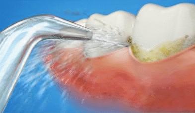 很小的牙缝会恢复吗,牙缝大了能有补救吗