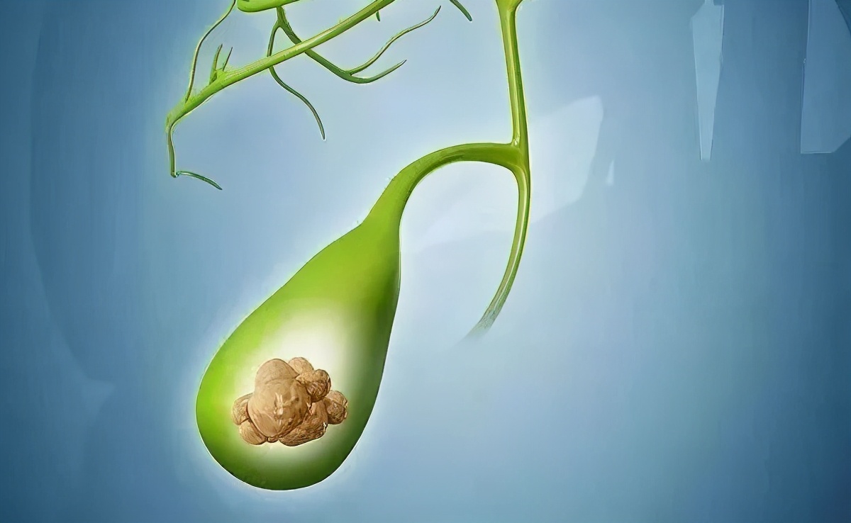 山东齐鲁医院胆囊结石保胆取石,多大的结石可以保胆取石