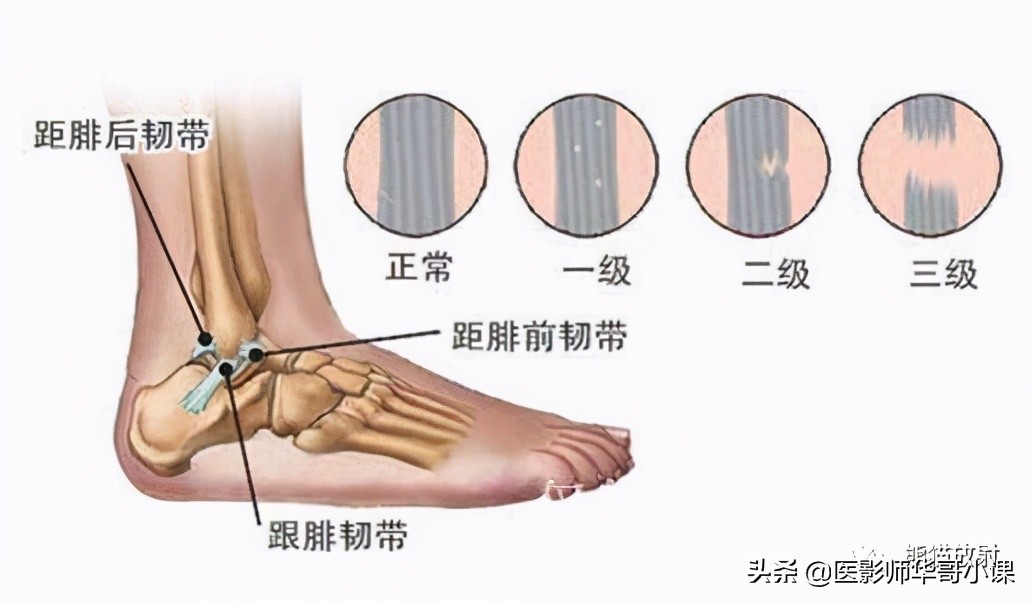 踝关节解剖视频课,解剖学韧带分布图