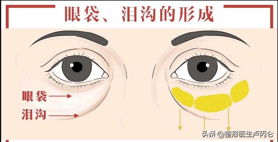 眼袋手术的副作用有哪些,眼袋手术最常见的并发症是