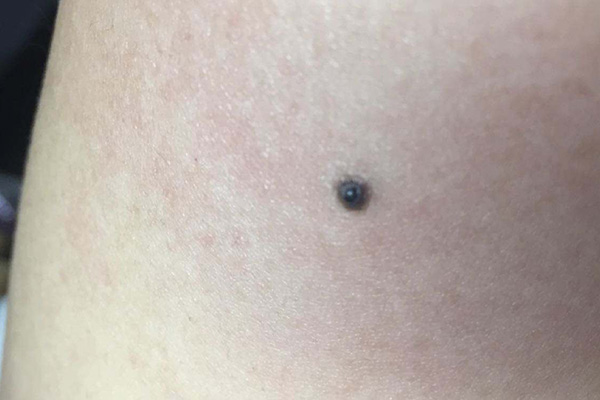 痣上长毛正常吗,脖子后面正中间有痣并且痣上长毛