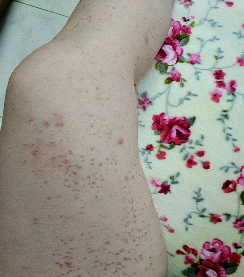 肝病身上出现小红点是怎么回事,肝病患者身上出现小红点意味什么