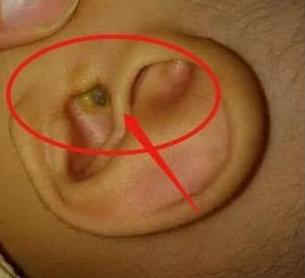 4岁孩子说耳朵疼然后夜晚发烧,4岁小男孩耳朵疼是怎么回事