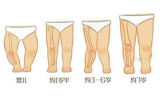 膝外翻超过15度怎么办,膝内翻或膝外翻的原因