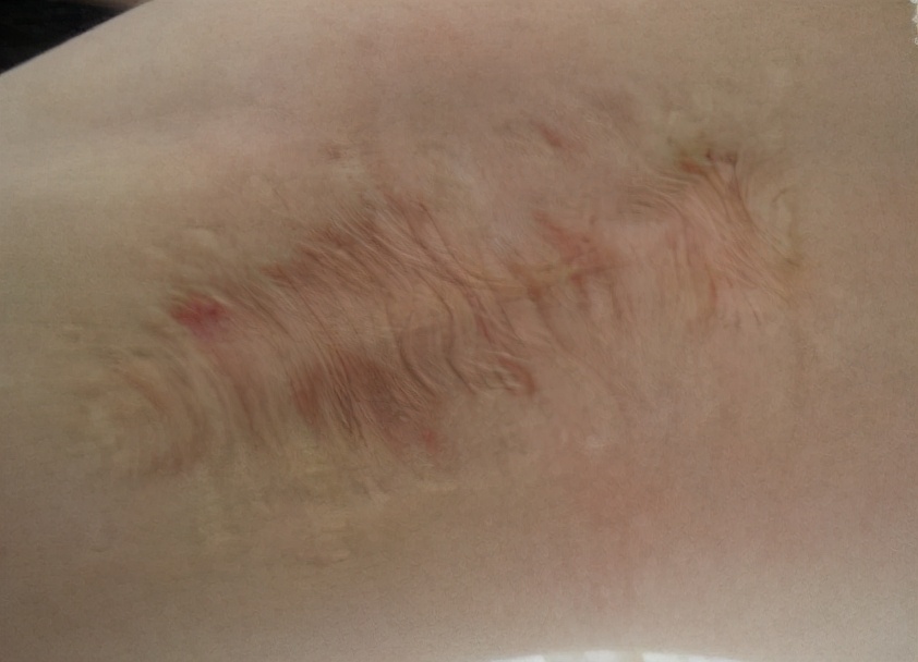 狐臭是怎么引起的,狐臭是怎么引起的啊