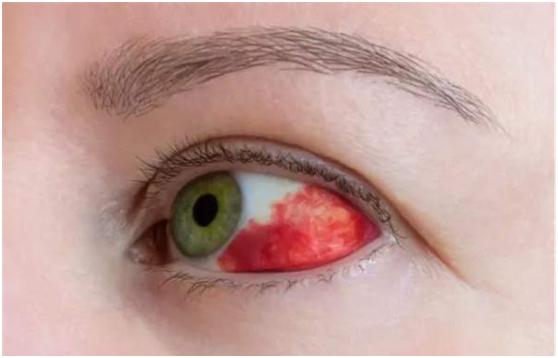 便秘引起眼睛充血是怎么回事,便秘会引起眼睛红血丝吗