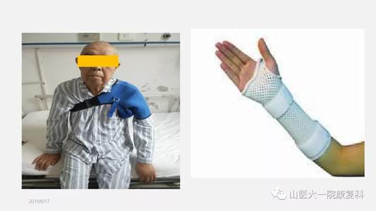 偏瘫肩肿怎么回事,偏瘫患者手肿怎么办