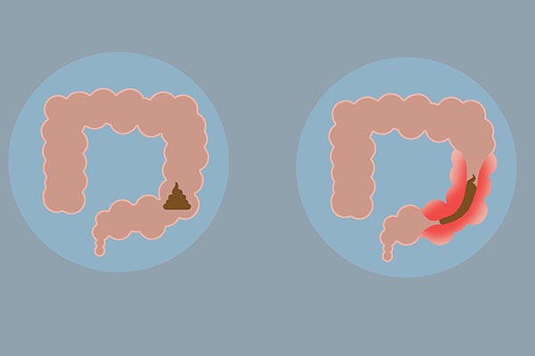 肛门坠胀屁多是什么原因,肛门有坠胀感是什么原因吃什么药