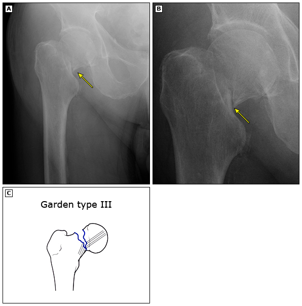 29岁右股骨颈骨折恢复最佳的方法,82老人股骨头摔骨折了该怎样治疗