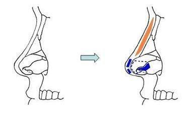 隆鼻土耳其糖块,土耳其软糖隆鼻鼻尖会显形吗