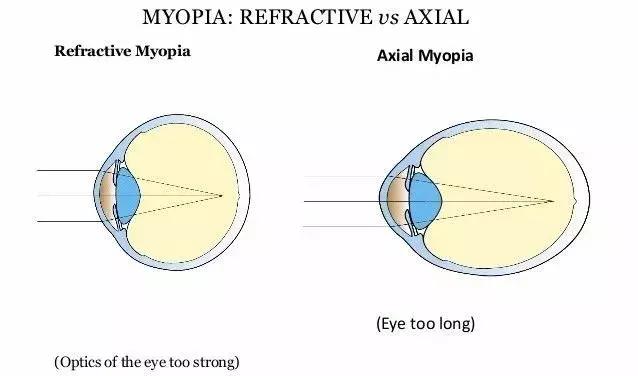 假性近视是真的近视了吗,假性近视是骗局吗