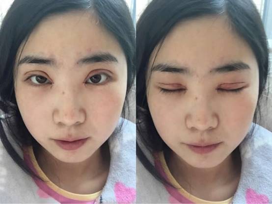 上海整容双眼皮多少钱,上海整形医院割双眼皮要多少钱