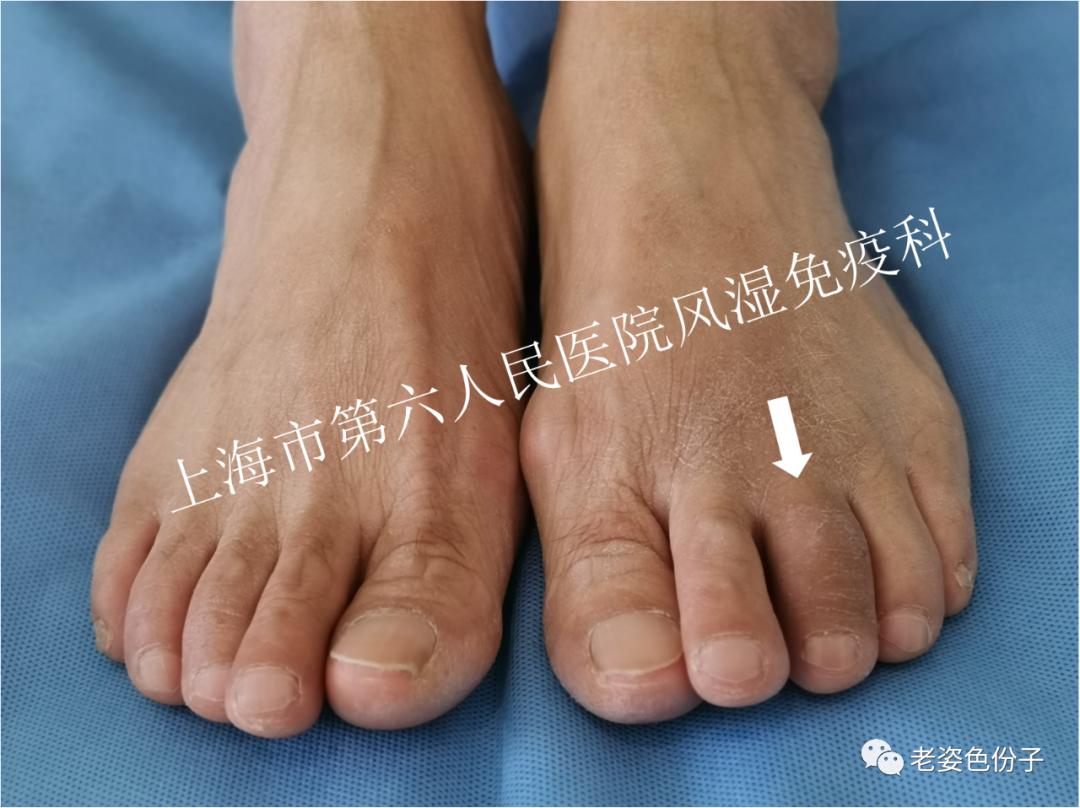 银屑病脚趾关节浮肿是怎么回事,银屑病关节炎会使脚趾根部痛吗