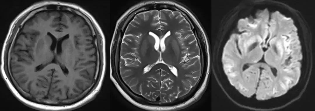 纠正低钠后患者昏迷,纠正低钠用什么药