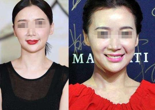 瘦脸针三针是否真的定型,瘦脸针是什么原理有副作用吗