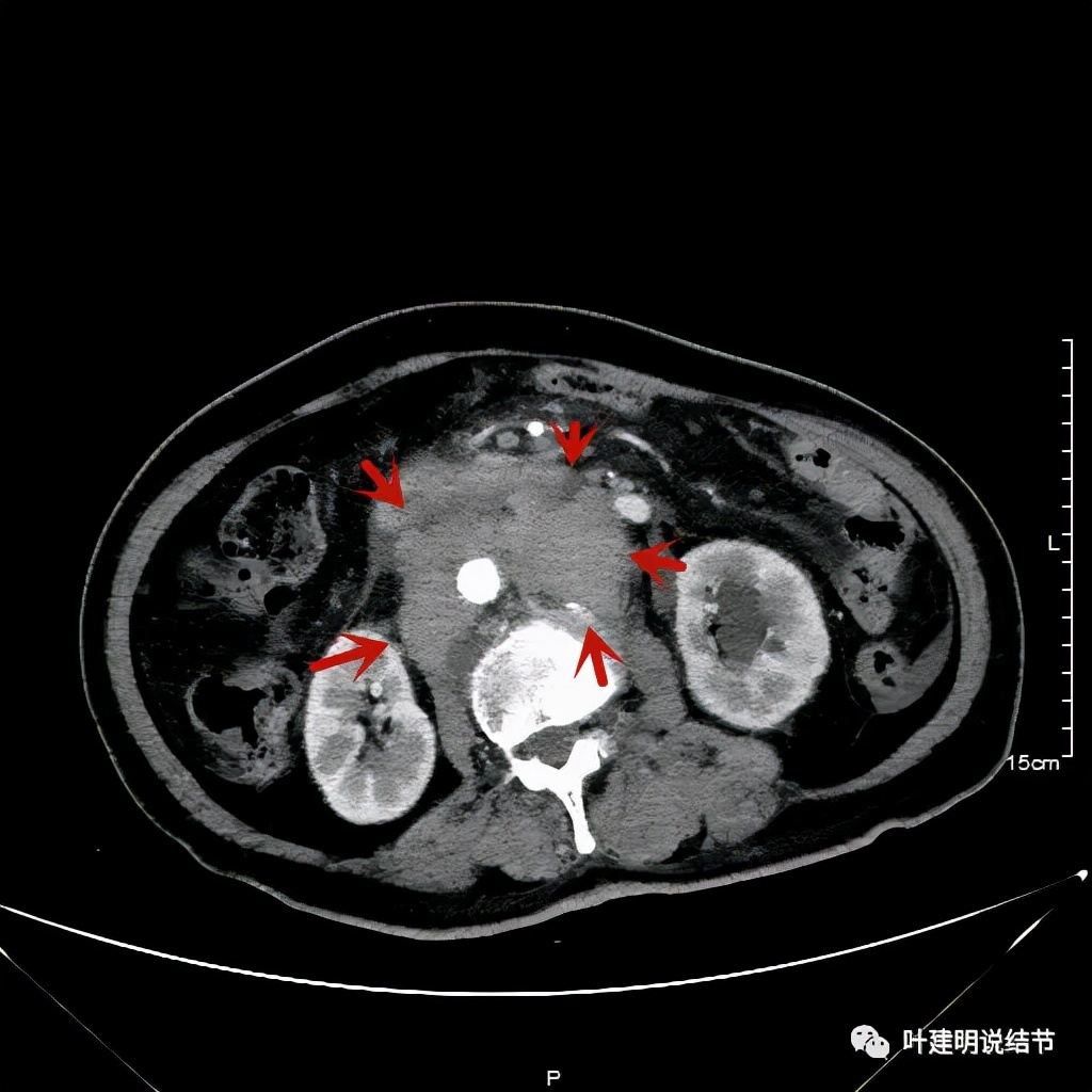 特瑞普利单抗食管癌成功案例,特瑞普利单抗治疗食管癌效果好吗