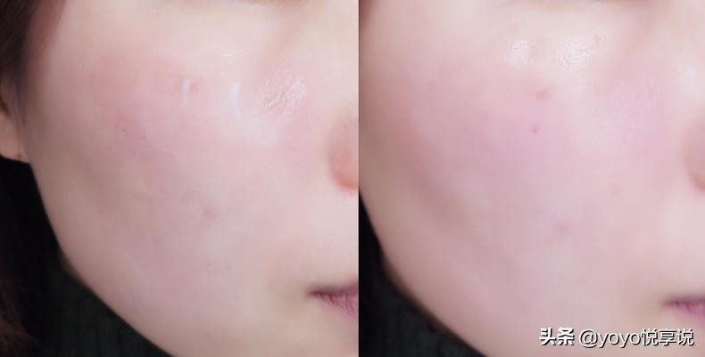 冬季脸上泛红敏感肌应该抹什么,换季春季脸干燥脱皮紧绷刺痛水乳