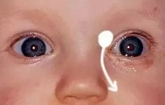 新生宝宝眼屎多什么原因,新生宝宝眼屎黄脓状怎么办