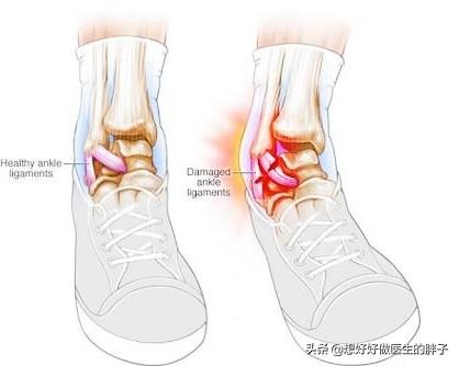 关于踝关节扭伤的正确处理方法,崴脚得重视