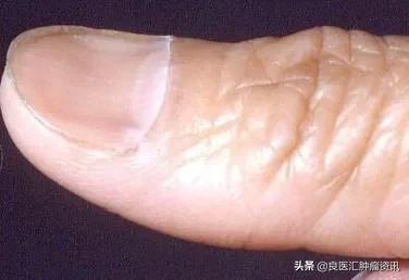 缺铁性贫血和消化道肿瘤,肿瘤患者缺铁性贫血