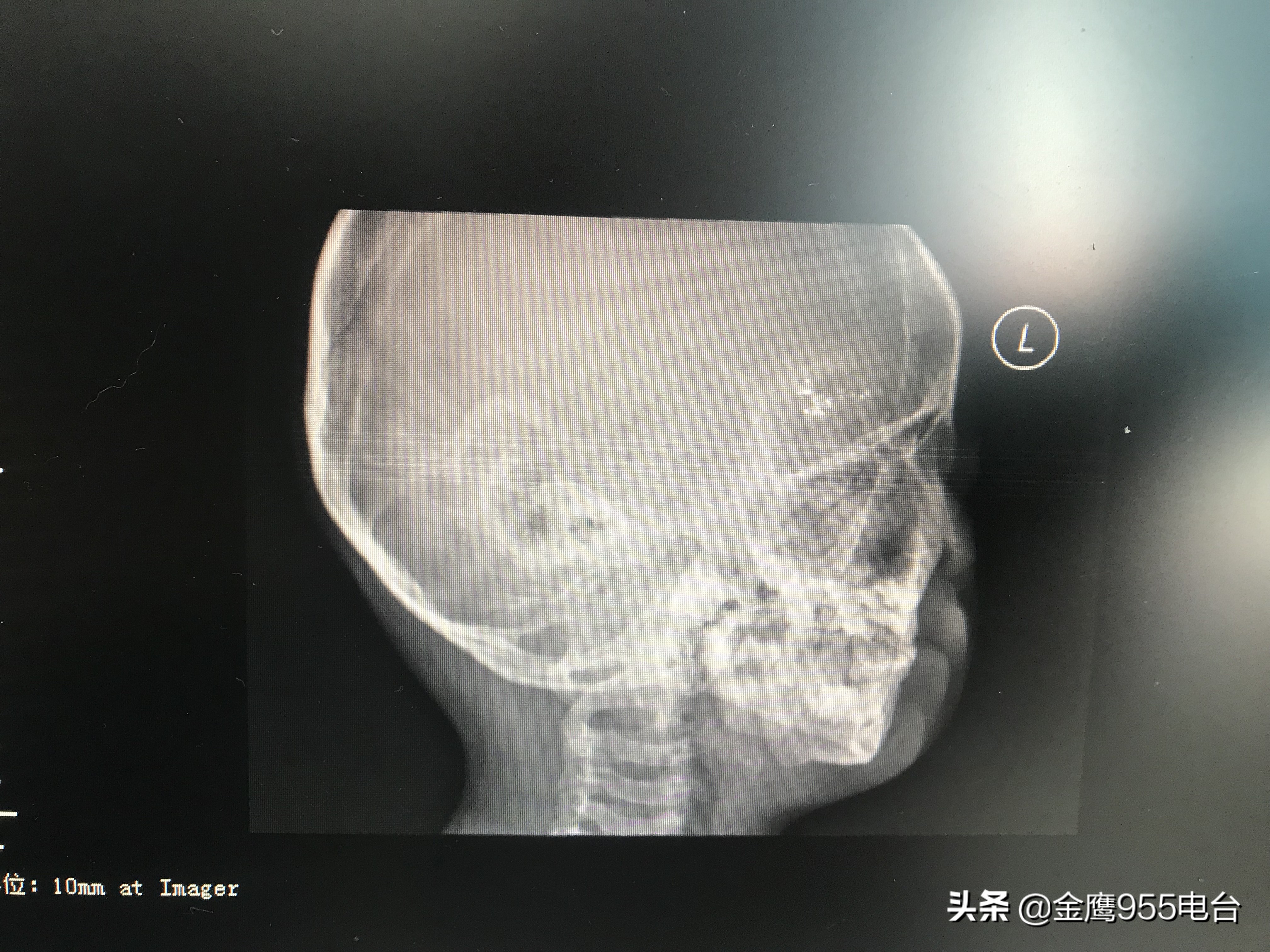 家长注意了！男孩不慎摔倒温度计插入眼眶三年驱汞治疗仍有残余