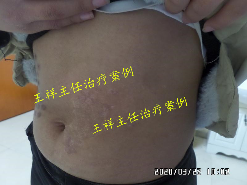 白癜风黑色素种植效果好吗,黑色素种植治疗白癜风费用