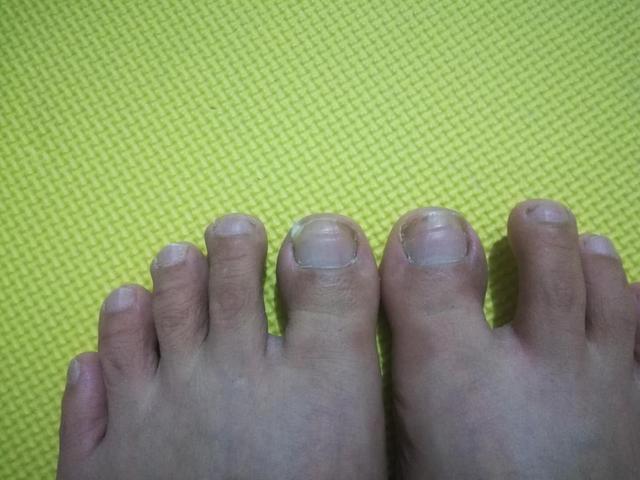 摆脱甲沟炎的痛苦之后的感想,甲沟炎的亲身经历