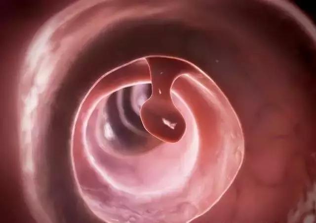 肠镜检查发现息肉应该怎么办,肠镜检查出息肉会当场割掉吗