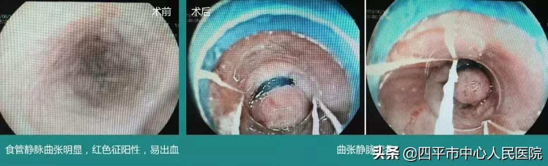 四平中心医院治疗静脉曲张,食管静脉曲张精准化治疗