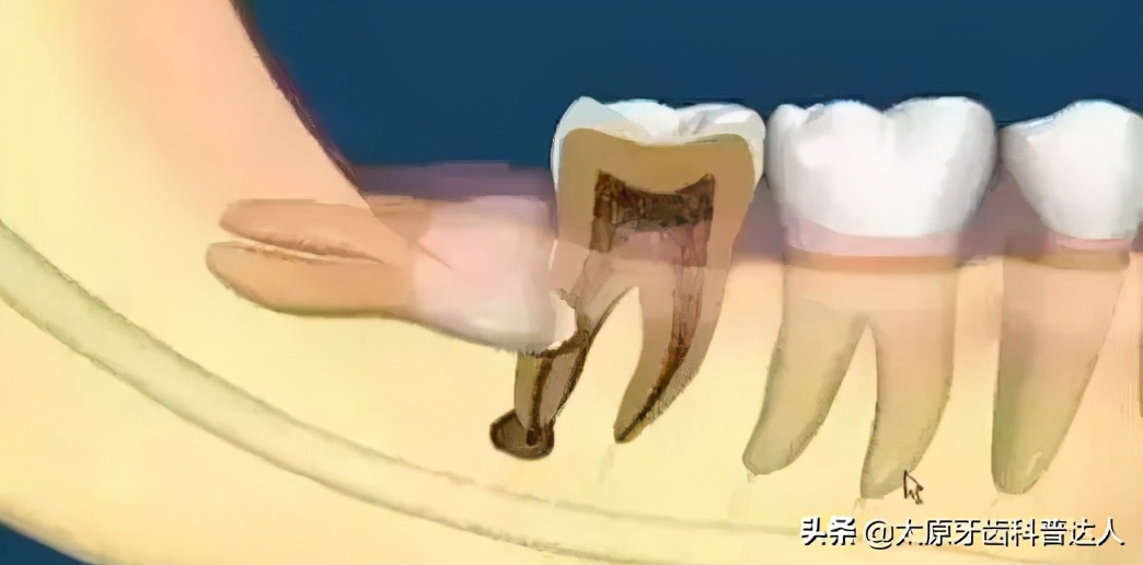 横着长的智齿一定要拔掉吗,横着长的智齿怎么拔出