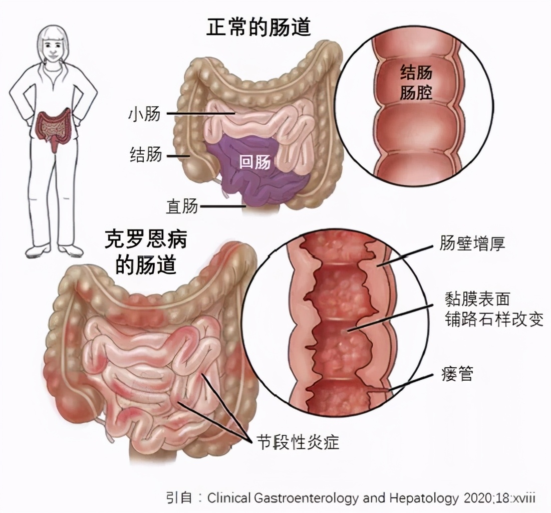 急性肠胃炎和肠穿孔,一种肠穿肚烂的疾病盯上青少年
