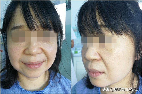 拉皮手术可以去除眼下细纹吗,拉皮手术能去除苹果肌吗