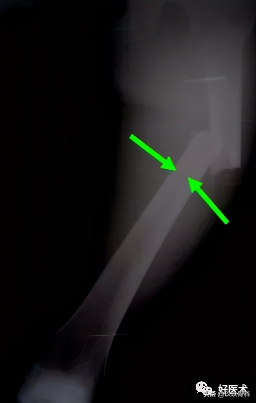 髓内钉技巧,髓内钉教学视频讲解